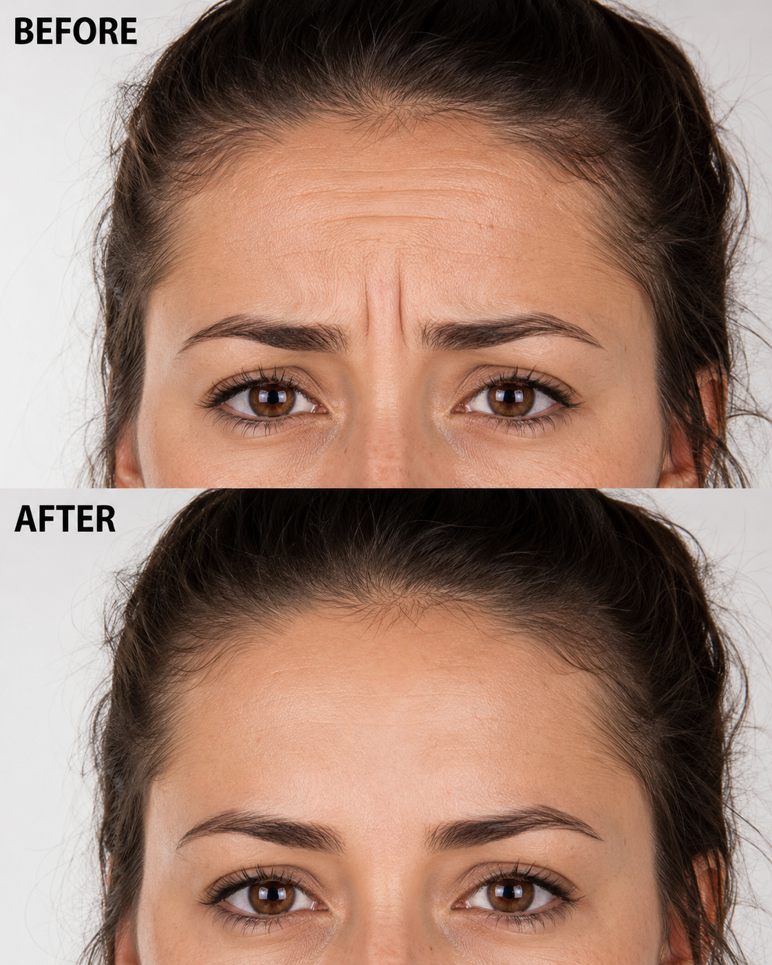 Anti Wrinkle Treatment — before and after 2
